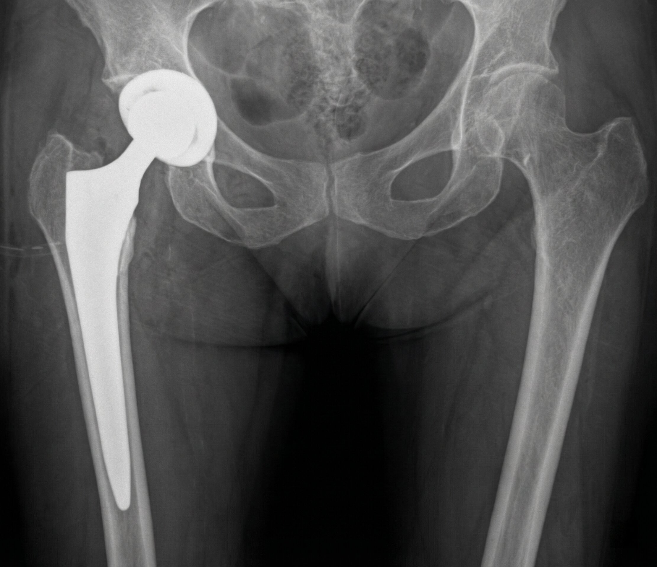 Coxartrosi: Protesi di Anca