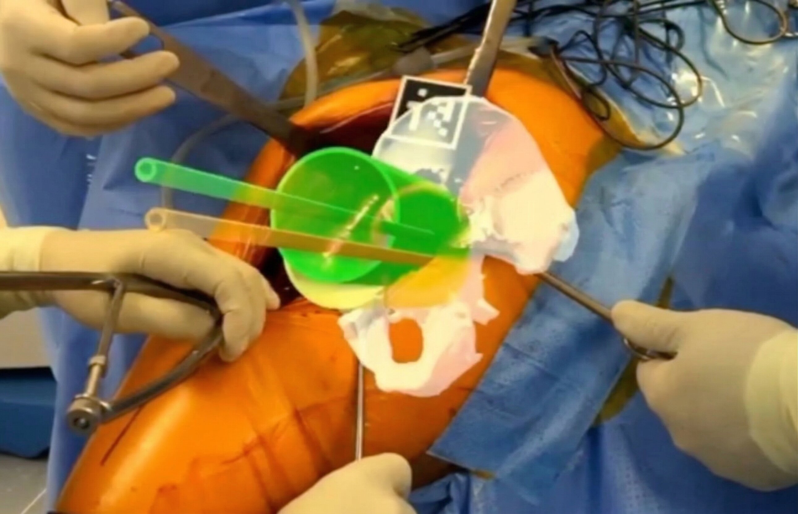 Infezioni Protesiche: Revisione