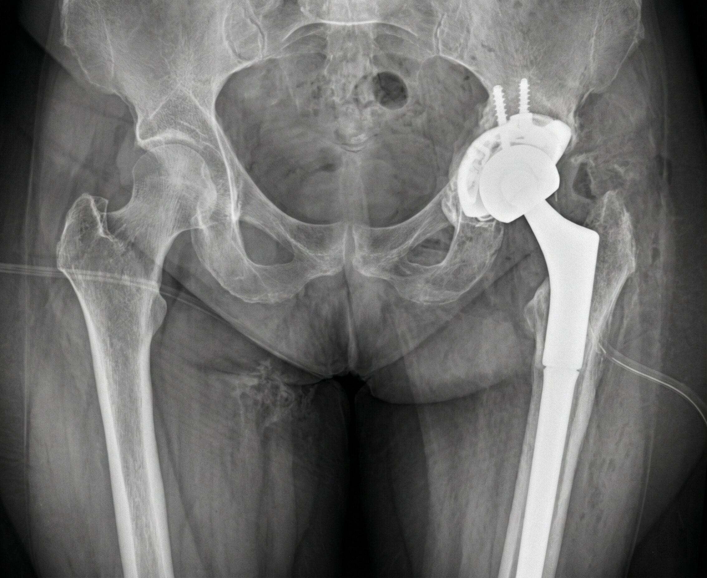 Infezioni Protesiche: Revisione