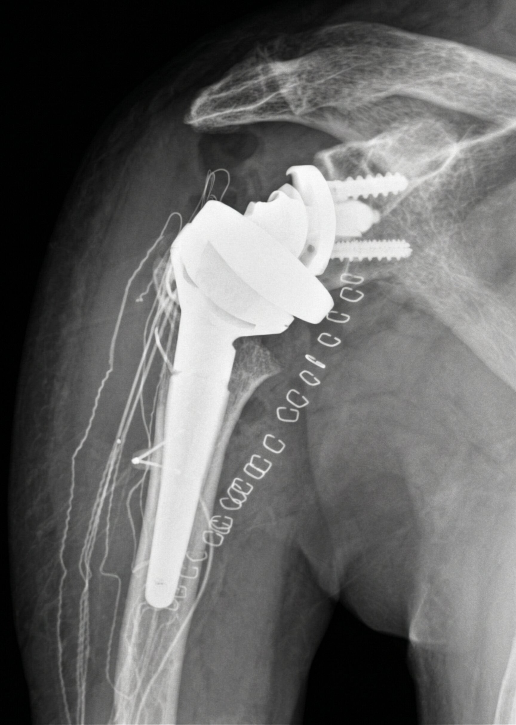 Omartrosi: Protesi di Spalla