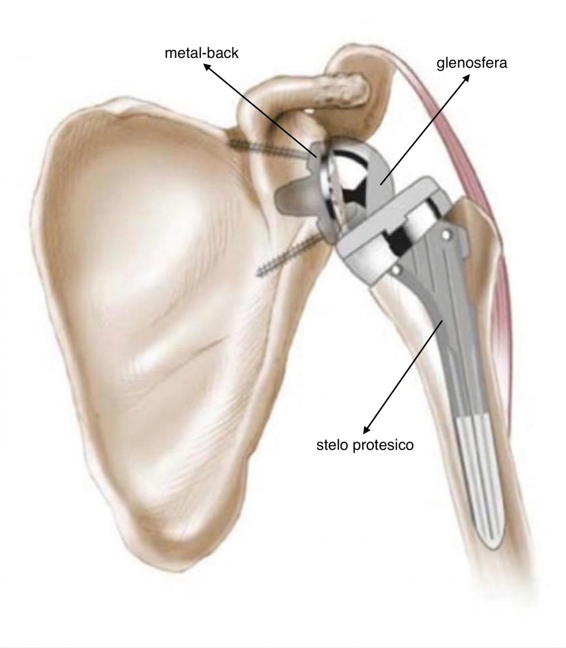Omartrosi: Protesi di Spalla