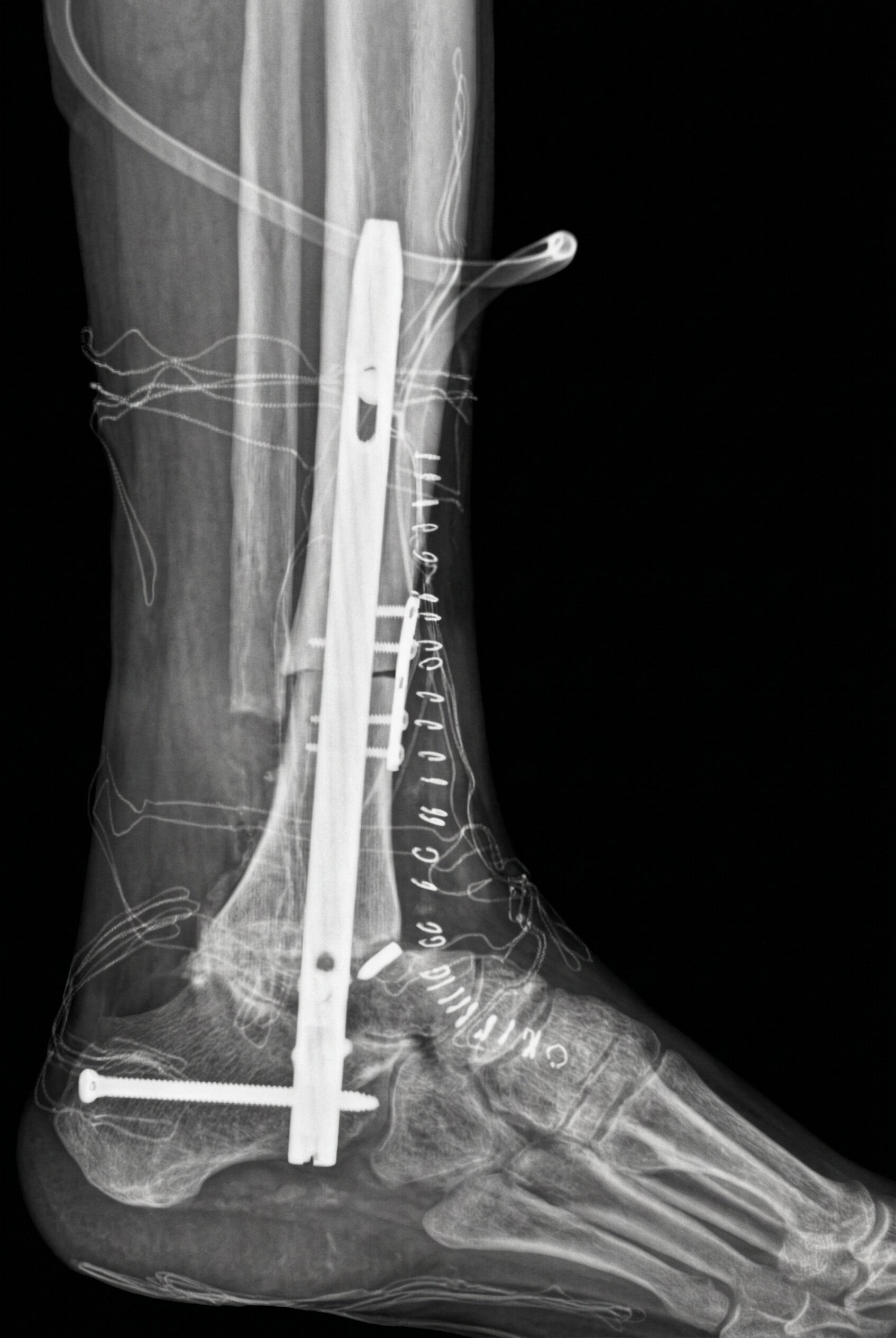 Tumori dell’Osso e Tessuti Molli